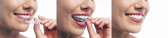 invisalign